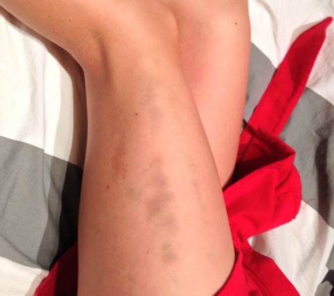 IT band syndrome bruise running injury 